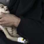 Woman holds her malnourished child at a therapeutic feeding center at al-Sabyeen hospital in Sanaa