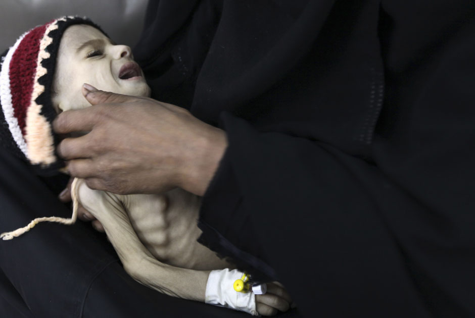 Woman holds her malnourished child at a therapeutic feeding center at al-Sabyeen hospital in Sanaa