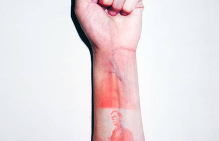 Sunburns Pictures Printed on Bodies