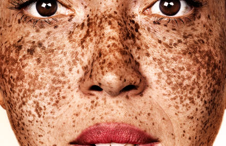 Stunning Beauty of Freckled Individuals