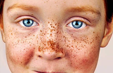 Stunning Beauty of Freckled Individuals